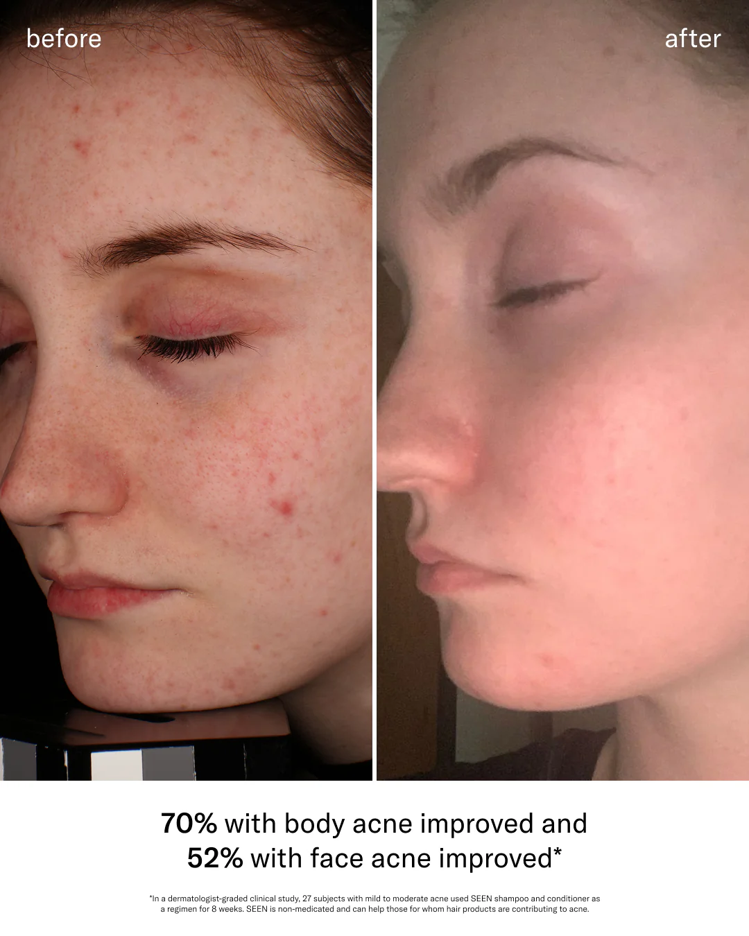SEEN Acne-Safe Bundle - Image 5